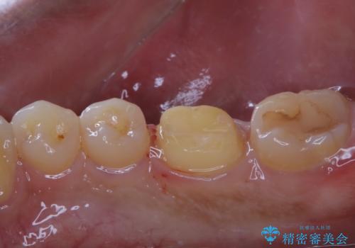 銀歯をセラミックにの治療中