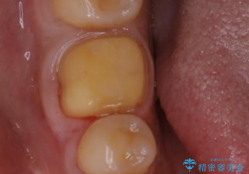 銀歯をセラミックにの治療中