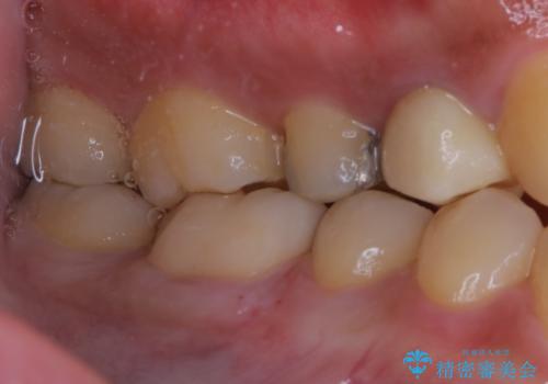 銀歯をセラミックにの治療後