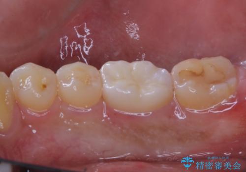 銀歯をセラミックにの治療後