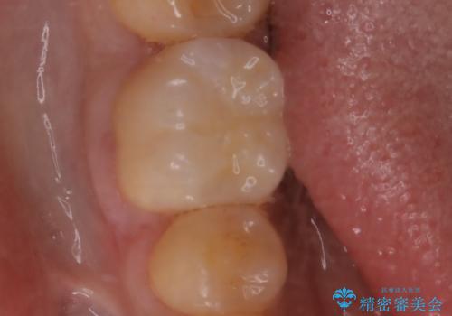 銀歯をセラミックにの治療後