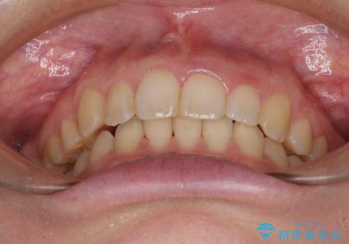 気になる八重歯を治したい インビザラインと補助装置を用いた抜歯治療の治療後