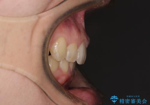 気になる八重歯を治したい インビザラインと補助装置を用いた抜歯治療の治療後