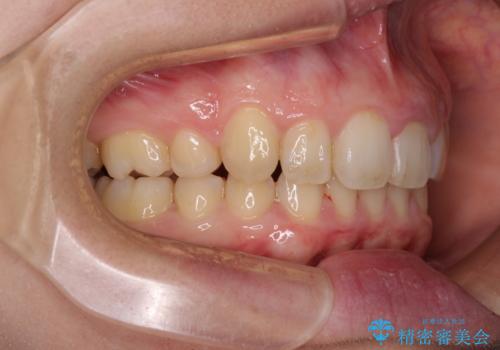 気になる八重歯を治したい インビザラインと補助装置を用いた抜歯治療の治療後