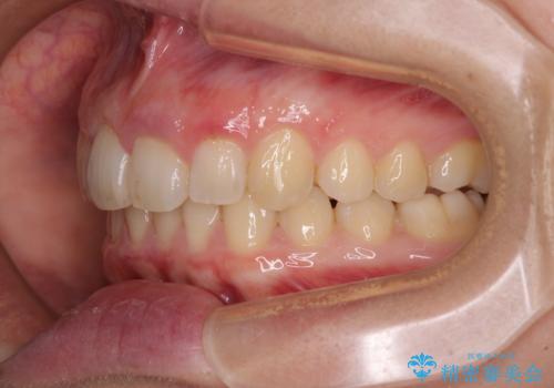 気になる八重歯を治したい インビザラインと補助装置を用いた抜歯治療の治療後