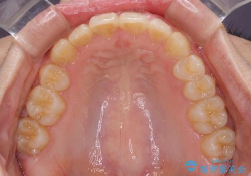 気になる八重歯を治したい インビザラインと補助装置を用いた抜歯治療の治療後