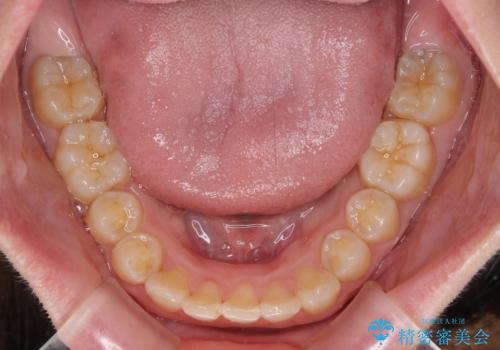 気になる八重歯を治したい インビザラインと補助装置を用いた抜歯治療の治療後
