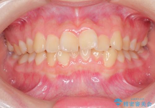 上下の前歯のガタガタを目立たず治したい インビザラインによる見えない矯正の症例 治療前