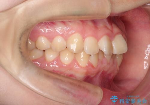 上下の前歯のガタガタを目立たず治したい インビザラインによる見えない矯正の治療前