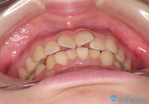 上下の前歯のガタガタを目立たず治したい インビザラインによる見えない矯正の治療前