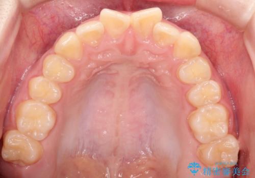上下の前歯のガタガタを目立たず治したい インビザラインによる見えない矯正の治療前