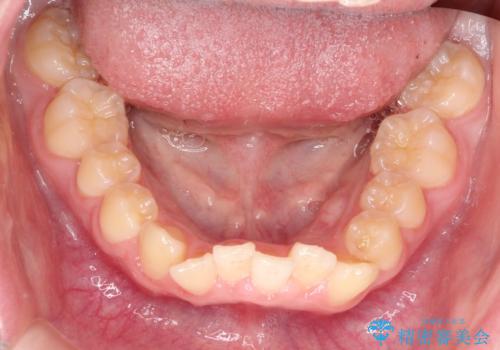 上下の前歯のガタガタを目立たず治したい　インビザラインによる見えない矯正の治療前