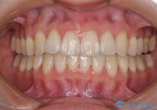 海外留学をしながら歯並びを整えたい インビザラインによる矯正治療の症例 治療後