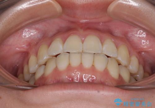 海外留学をしながら歯並びを整えたい インビザラインによる矯正治療の治療後