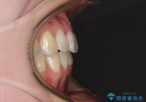 海外留学をしながら歯並びを整えたい インビザラインによる矯正治療の治療後