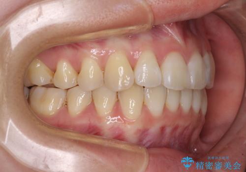 海外留学をしながら歯並びを整えたい インビザラインによる矯正治療の治療後