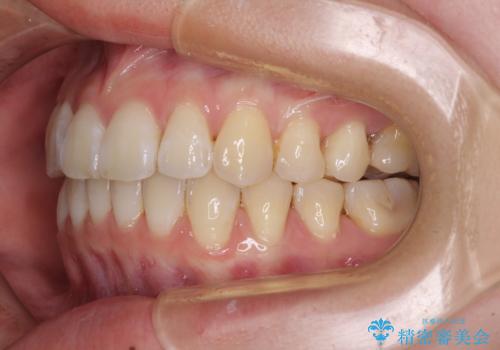 海外留学をしながら歯並びを整えたい インビザラインによる矯正治療の治療後