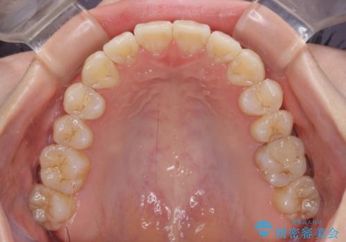 海外留学をしながら歯並びを整えたい インビザラインによる矯正治療の治療後