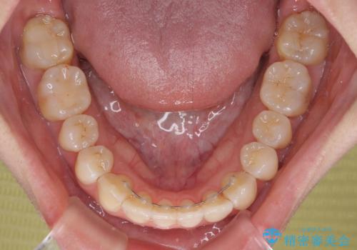 海外留学をしながら歯並びを整えたい インビザラインによる矯正治療の治療後