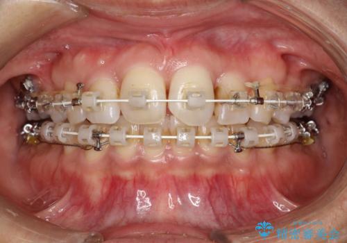 ワイヤー矯正中にステインOFFの症例 治療前