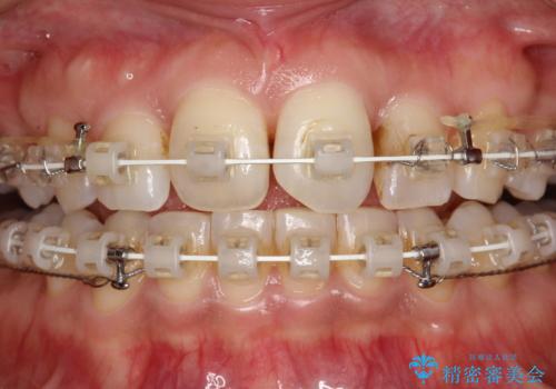 ワイヤー矯正中にステインOFFの治療前