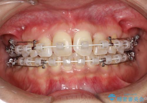 ワイヤー矯正中にステインOFFの症例 治療後