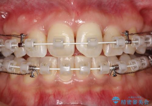 ワイヤー矯正中にステインOFFの治療後