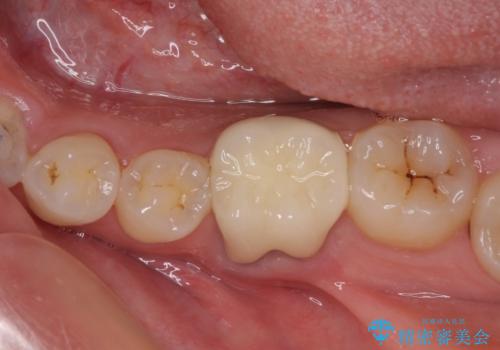 前歯のデコボコを治したい ワイヤー矯正の治療後