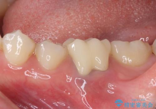 前歯のデコボコを治したい ワイヤー矯正の治療後