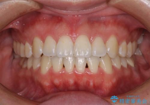 前歯のデコボコを治したい ワイヤー矯正の症例 治療後