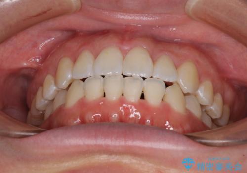 前歯のデコボコを治したい ワイヤー矯正の治療後