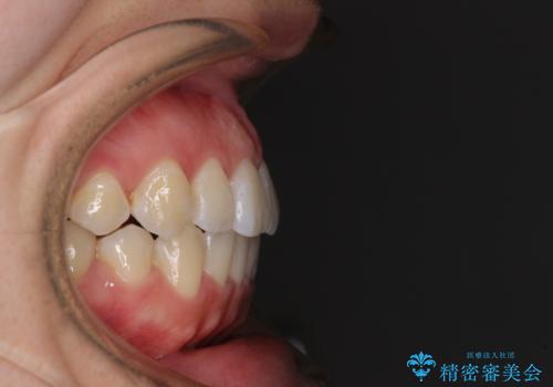 前歯のデコボコを治したい ワイヤー矯正の治療後
