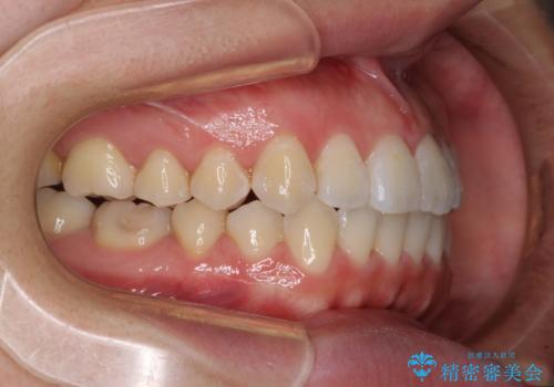 前歯のデコボコを治したい ワイヤー矯正の治療後