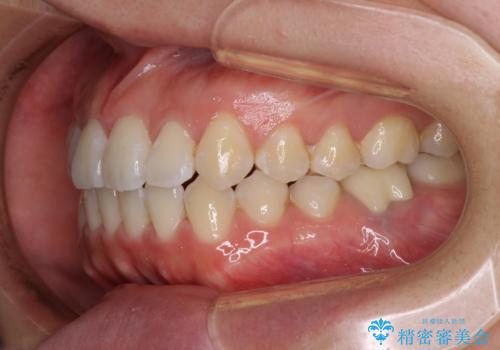 前歯のデコボコを治したい ワイヤー矯正の治療後