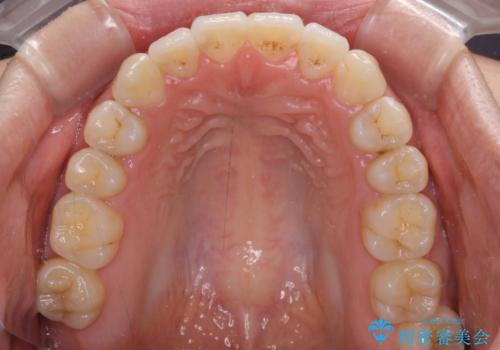 前歯のデコボコを治したい ワイヤー矯正の治療後