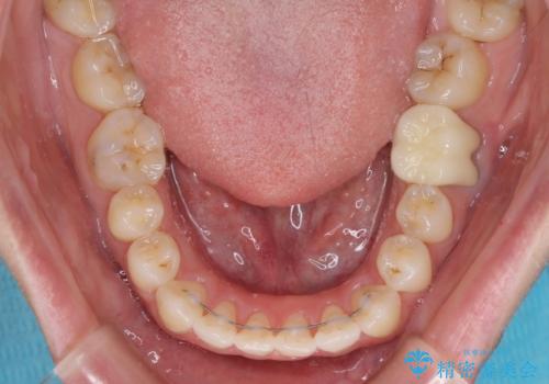 前歯のデコボコを治したい ワイヤー矯正の治療後