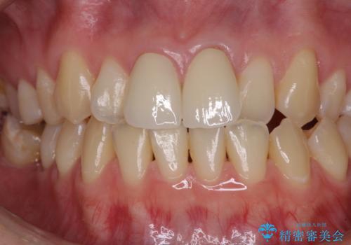 変色した前歯のオールセラミック治療の治療後