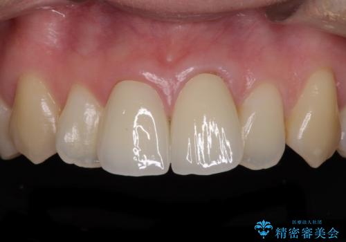 変色した前歯のオールセラミック治療の症例 治療後