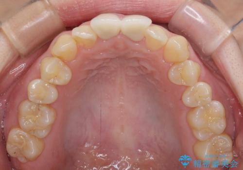 変色した前歯のオールセラミック治療の治療後