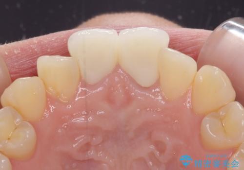 変色した前歯のオールセラミック治療の治療後