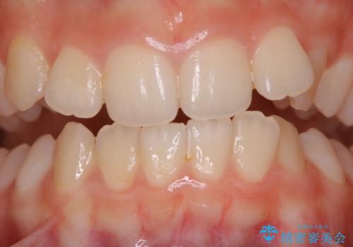 iTero スキャニングの前(invisalignの型どり)のPMTCの症例 治療前