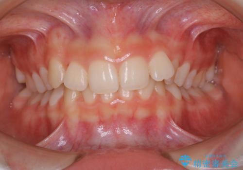 iTero スキャニングの前(invisalignの型どり)のPMTCの治療後