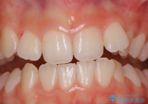iTero スキャニングの前(invisalignの型どり)のPMTCの症例 治療後