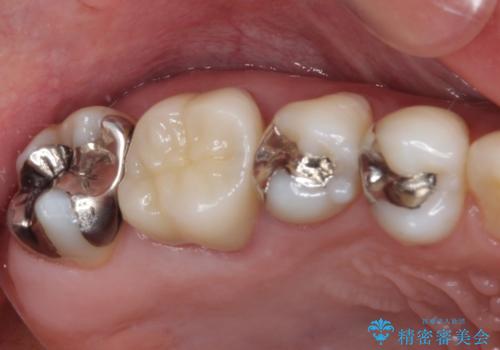 痛む奥歯 セラミッククラウンによるむし歯治療の症例 治療後