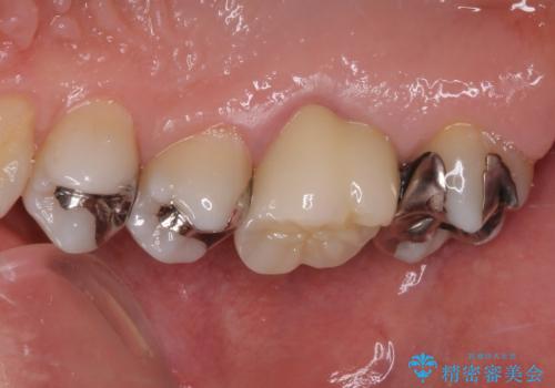 痛む奥歯 セラミッククラウンによるむし歯治療の治療後