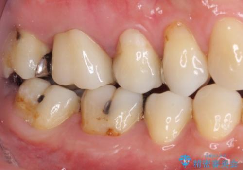 痛む奥歯 セラミッククラウンによるむし歯治療の治療後