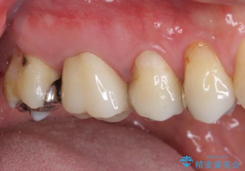 痛む奥歯 セラミッククラウンによるむし歯治療の治療後