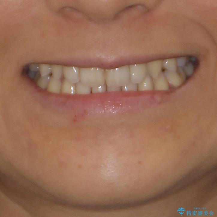 抜歯矯正の後戻りによるすきっ歯をインビザラインでの治療後（顔貌）