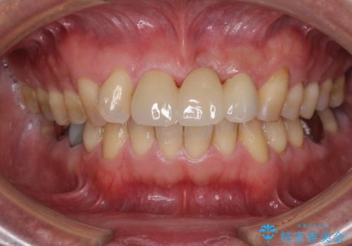 不自然な前歯のブリッジをオールセラミックできれいにの治療後