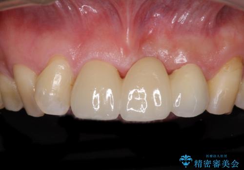 不自然な前歯のブリッジをオールセラミックできれいにの症例 治療後